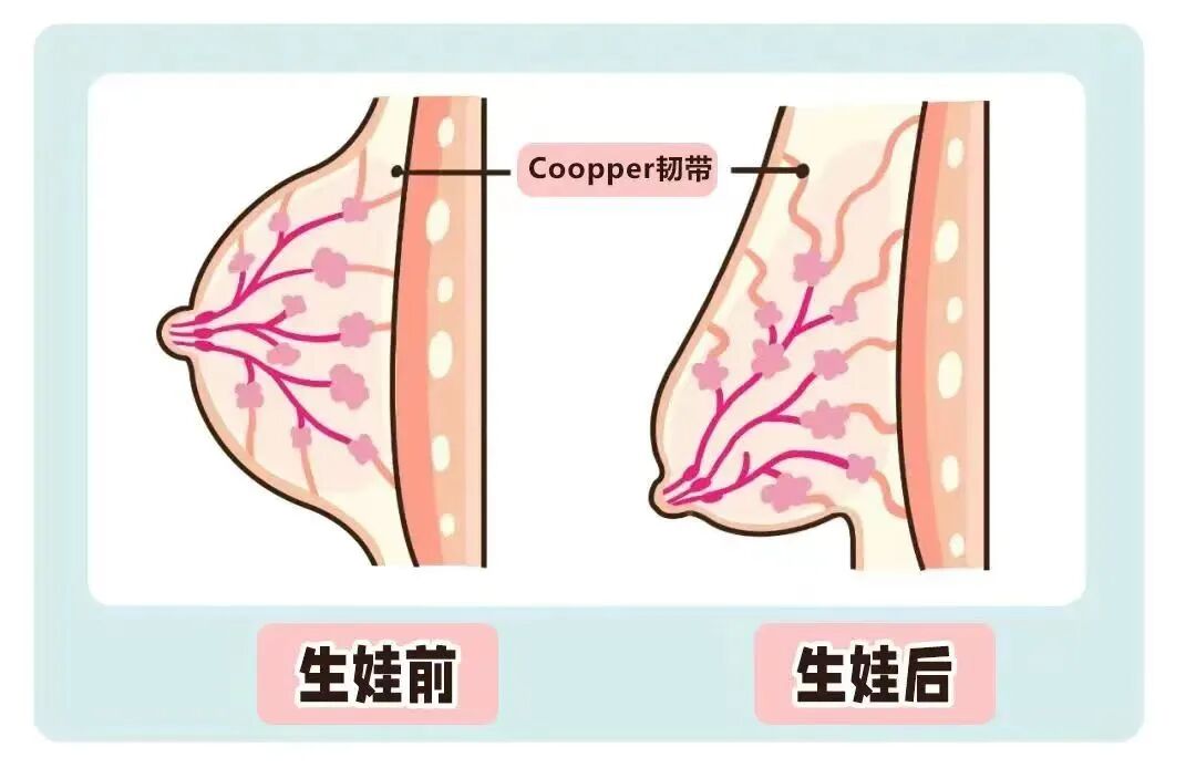 不同年龄隆胸,选哪款假体性价比更高?插图3 图片