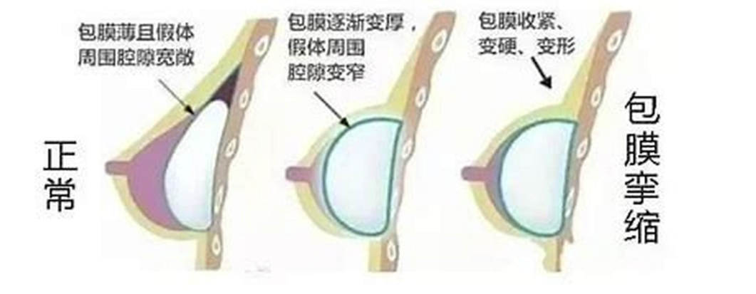 隆胸的假体可以在身体放多久?插图10 图片